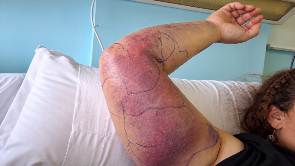 Mujer termina hospitalizada tras mordedura de culebra en Putaendo